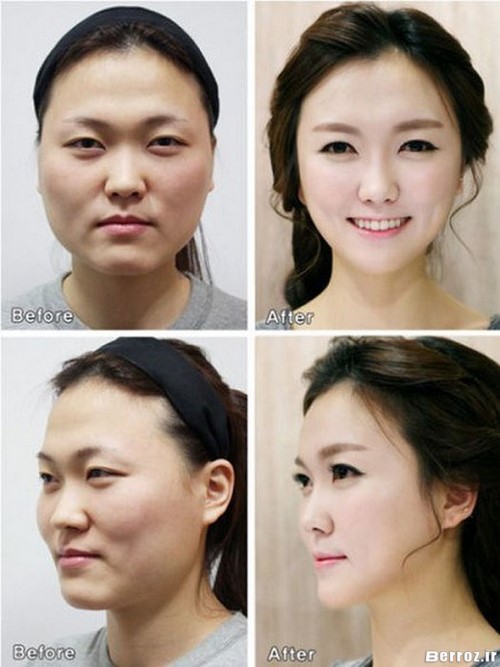 Cosmetic surgery (2)