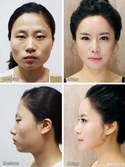 Cosmetic surgery (4)