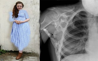 دختری که به سنگ تبدیل می شود+ عکس | بیماریهای نادر