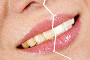 روشی موثر برای برطرف کردن زردی دندانها thooth yellow