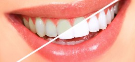 دندان های سفید بدون خمیر دندان